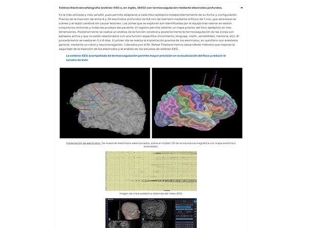accionlab-web-cirugia-epilepsia-3